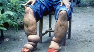 Bagaimana Mencegah Penyakit Kaki Gajah